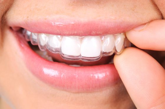 Close up of Invisalign tray over teeth